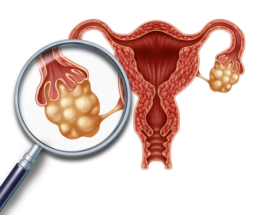 Induzione-Maturazione-Ovarica-ovaio-e-utero