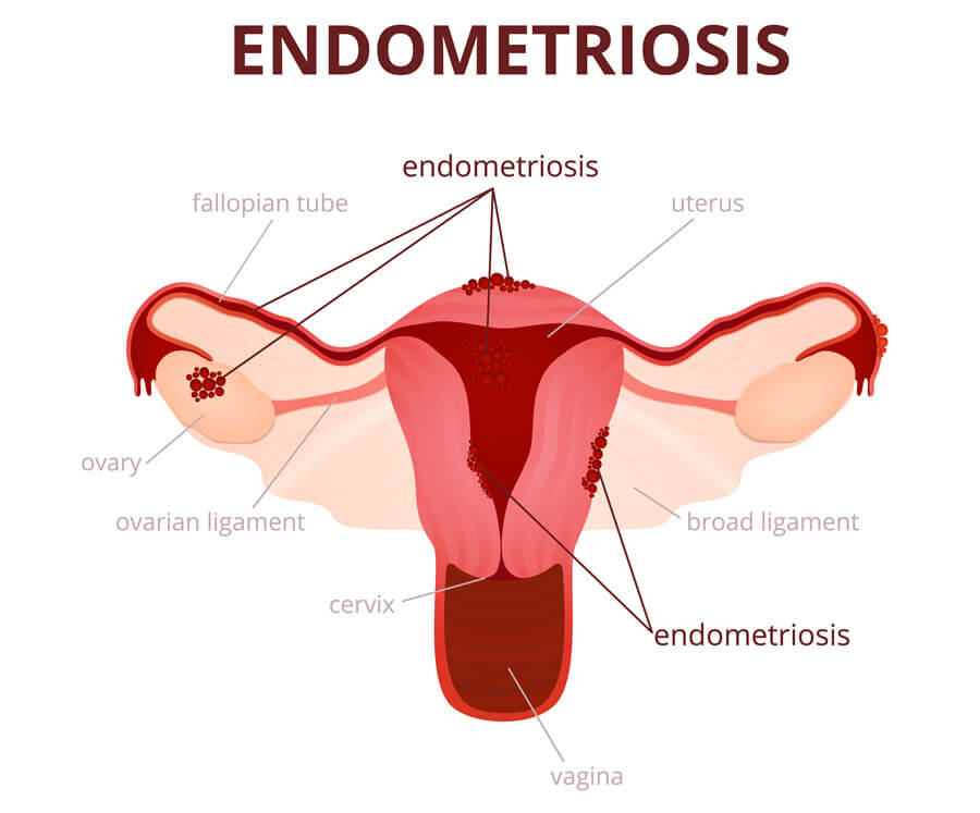 gravidanza-non-arriva-endometriosi