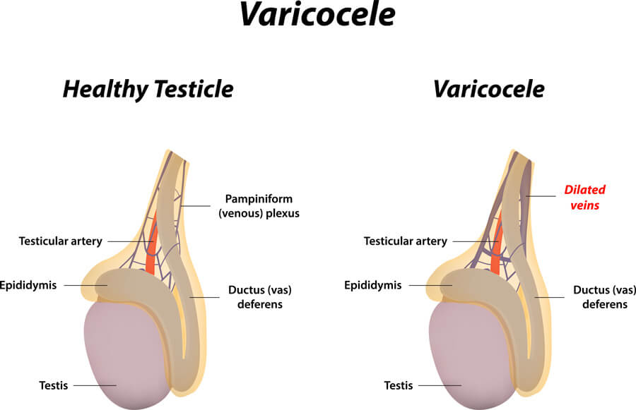 gravidanza-non-arriva-varicocele