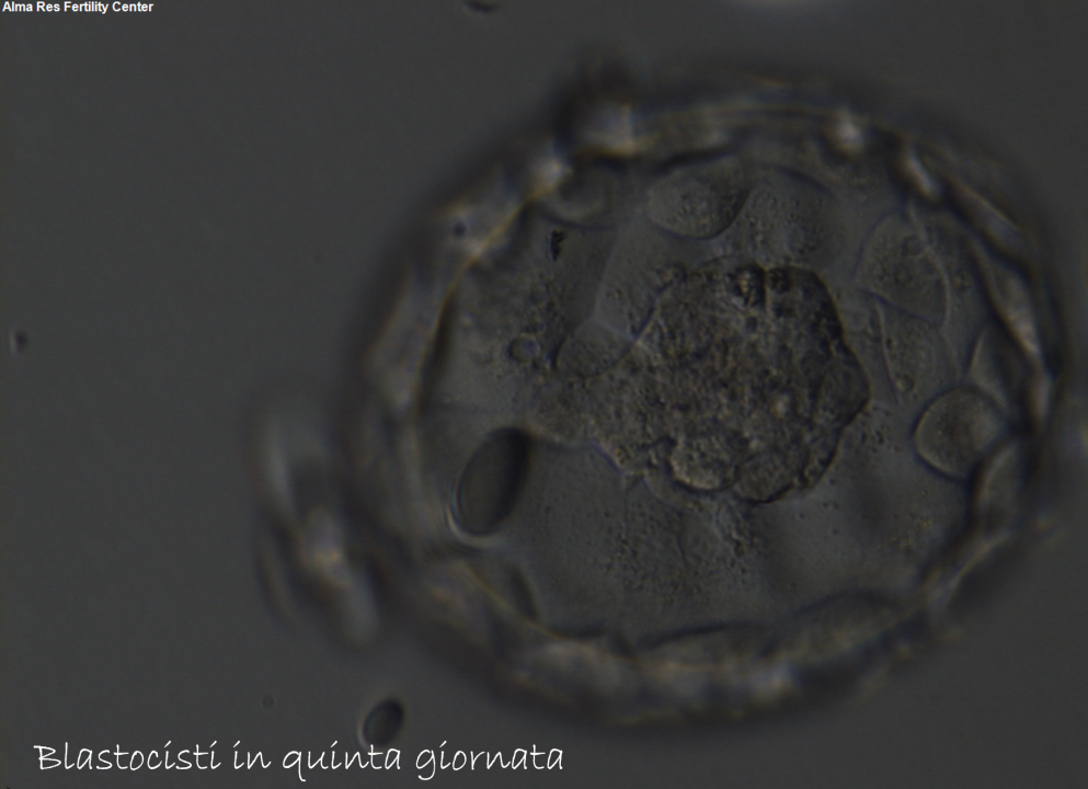 Test Gravidanza Dopo Transfer Blastocisti Congelate